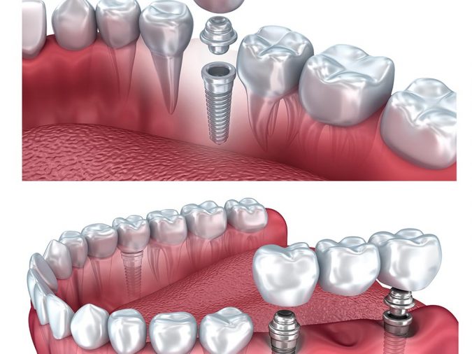 dental-implant-รากฟันเทียม