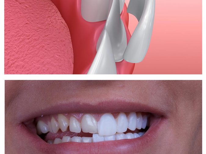 dental-veneer-เคลือบฟันเทียม