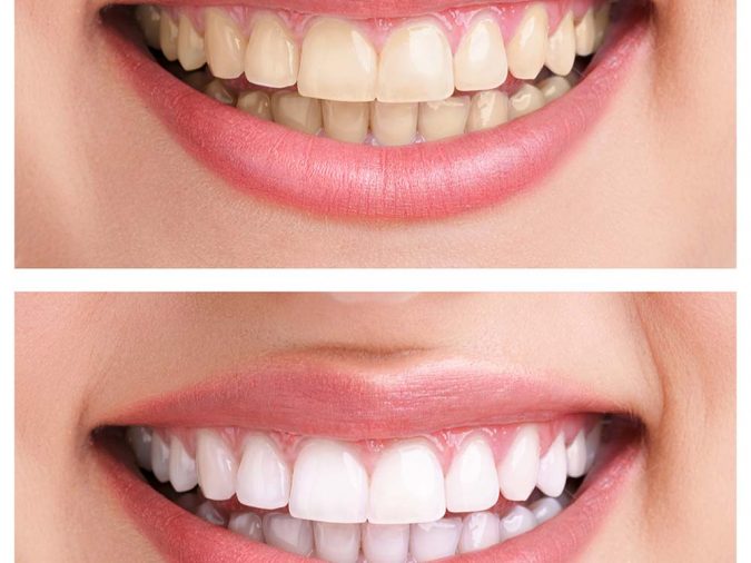 teeth-whitening-ฟอกสีฟัน