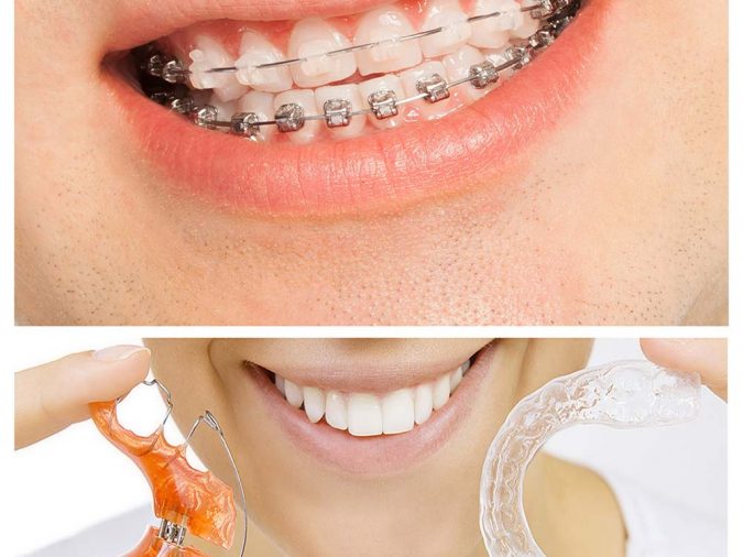 orthodontic-จัดฟัน-1