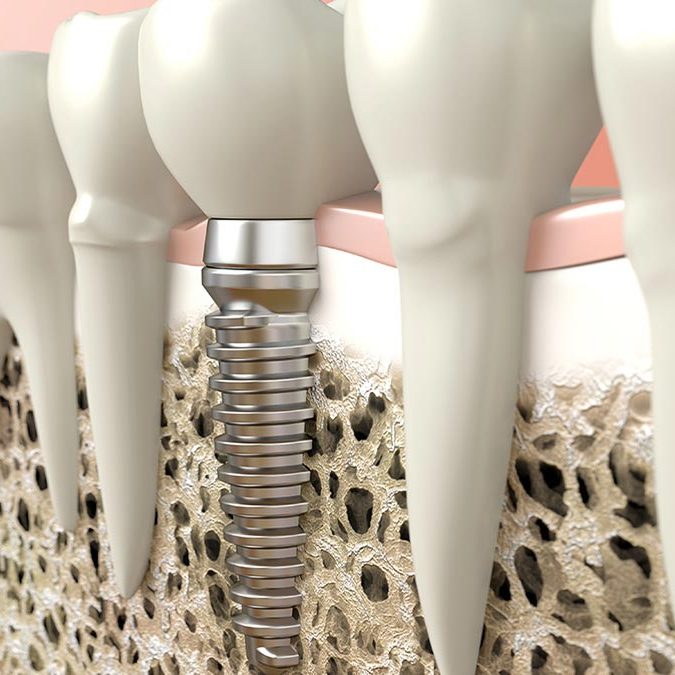 DentalImplant Central Pattaya Dental Center