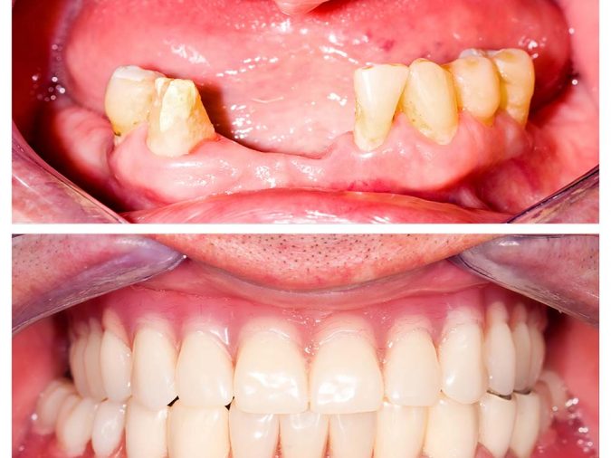 denture-ฟันปลอมถอดได้