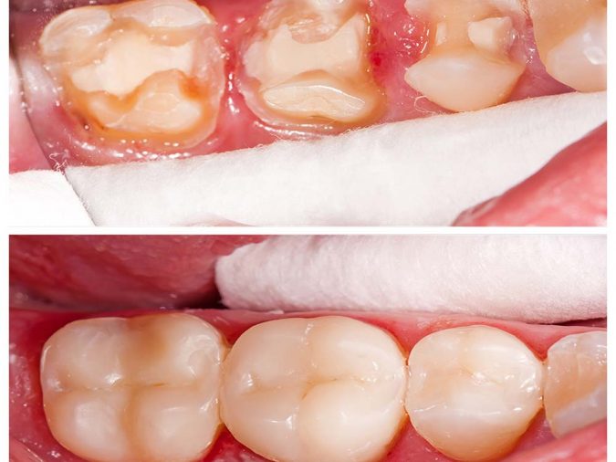 porcelain-inlay-onlay-อุดฟันด้วยเซรามิก