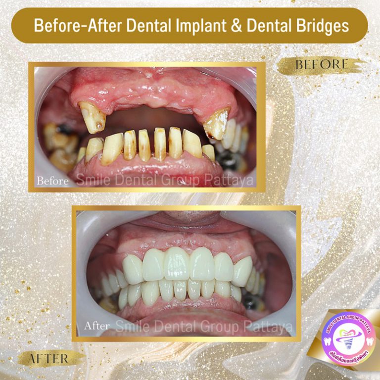 Pattaya Dental Implants Central Pattaya Dental Center