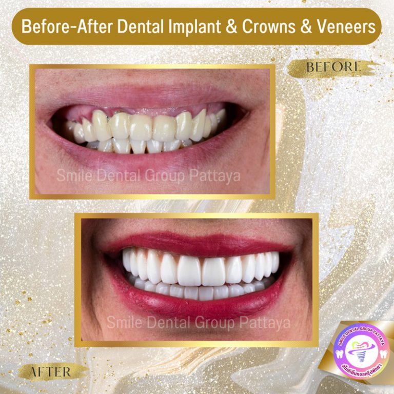 Pattaya Dental Implants Central Pattaya Dental Center