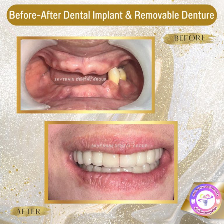 Pattaya Dental Implants Central Pattaya Dental Center
