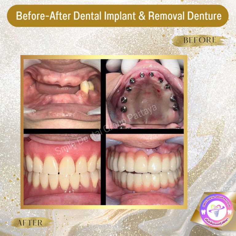 Pattaya Dental Implants Central Pattaya Dental Center