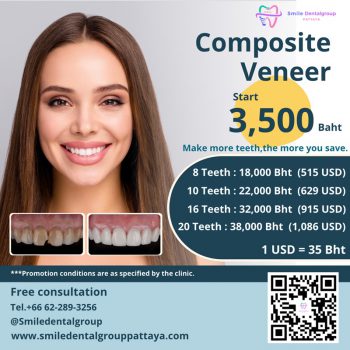 pro_veneer_en4