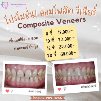 pro_veneer_th1