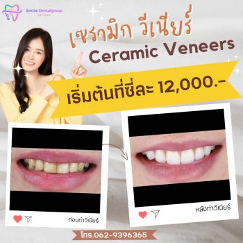 pro_veneer_th2