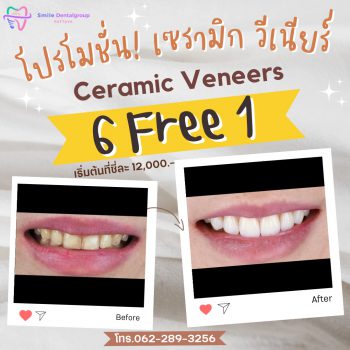 pro_veneer_th3