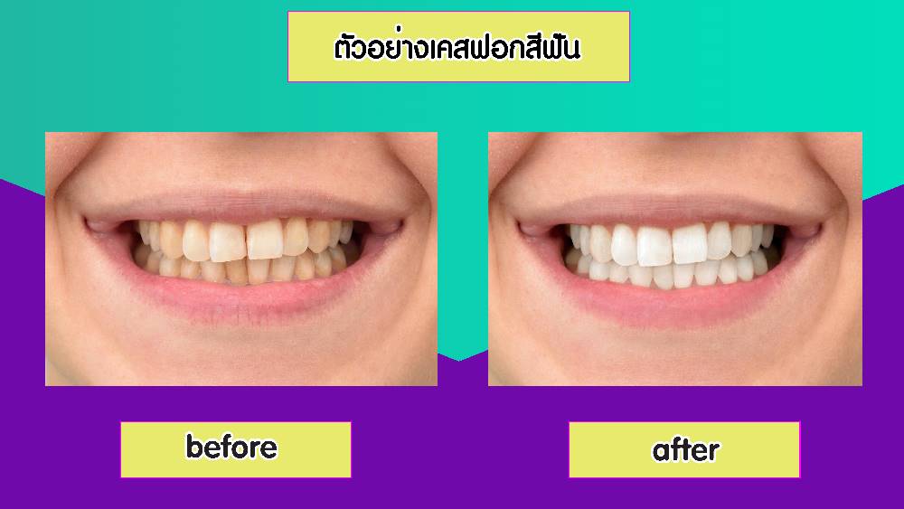 Laser Teeth Whitening Central Pattaya Dental Center