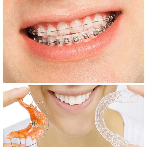 orthodontic-จัดฟัน-1