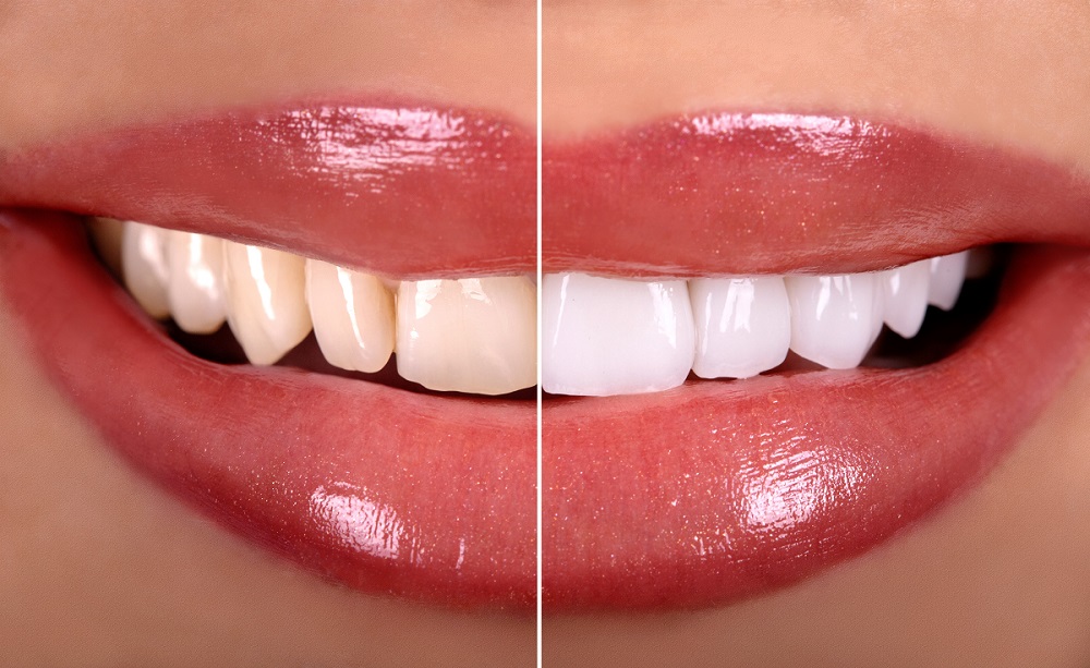 Comparing Teeth Whitening Cost With DIY Alternatives